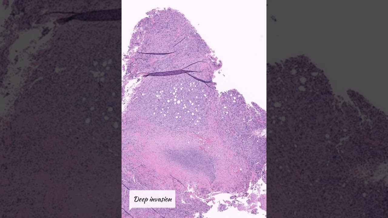 #pathology of pleomorphic dermal sarcoma #shorts #dermatology