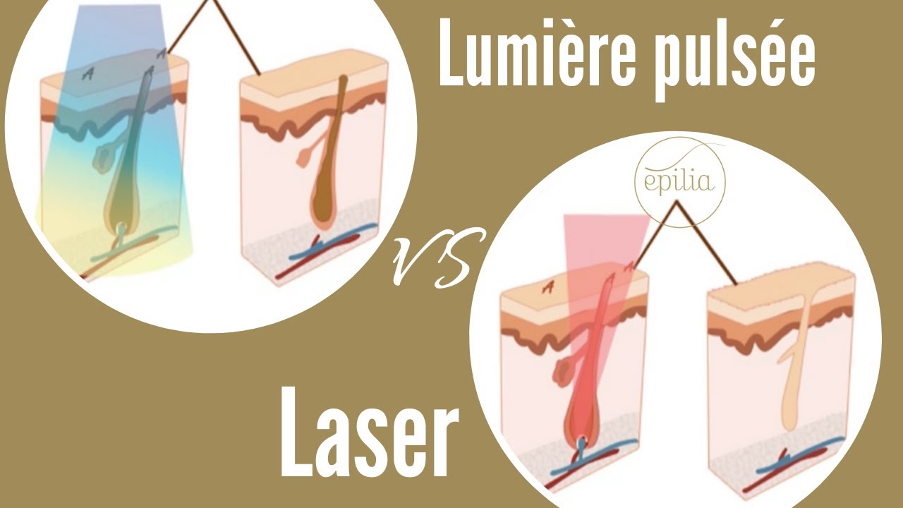 Epilation laser vs lumière pulsée : que choisir ? - YouTube