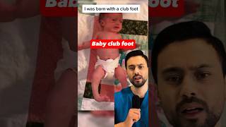 Baby Club Feet Treatment