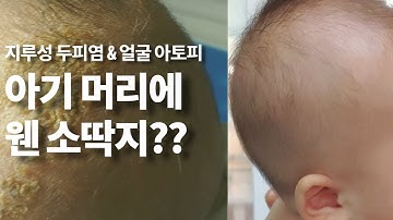 [아토피 완정후기 11편] 5개월아기 지루성두피염/얼굴아토피/ 진물아토피 리얼완정후기