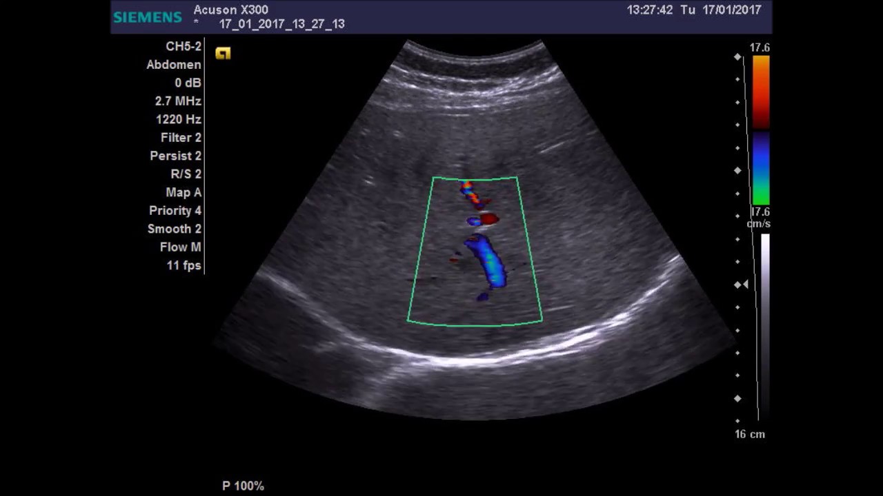 Очаговое образование правой доли печени