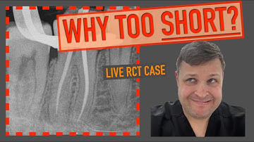 🚨 Endo Dilemma: Is This Root Canal Too Short? Apex Locator vs. X-Ray! 🔥