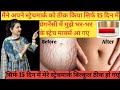 how to remove stretchmarks, stretchmarks ko theek kese kre, after delivery remove stretchmarks