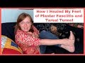 How I Healed My Feet from Plantar Fasciitis and Tarsal Tunnel