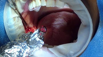 LIVE Patient Implant Training Institution of Dental Advancement Ramus Bone Harvesting Dr. Lastimado