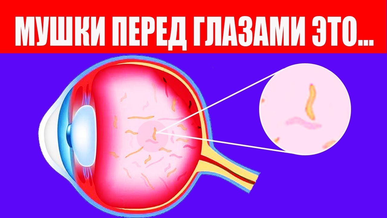 Как выглядят мушки перед глазами