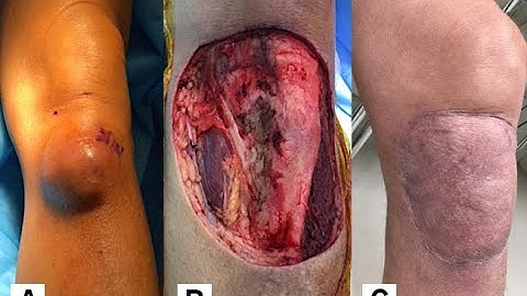 Excision Tumor soft tissue CPT code - simplify medical coding