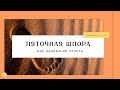 Как лечить пяточную шпору. Вся правда о реабилитации.