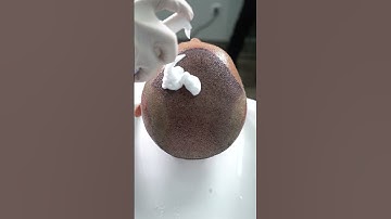 Thumbnail of First Hair Wash After the Hair Transplant || Long Hair Center Istanbul.