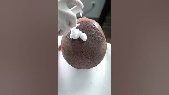 First Hair Wash After the Hair Transplant || Long Hair Center Istanbul.
