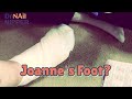 Is it time for Joanne's Foot Care?  How does lymphoma start? Dr Nail Nipper makes a Visit (2021)