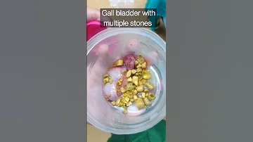 Gall Bladder With Multiple Stones Healthmedia 
