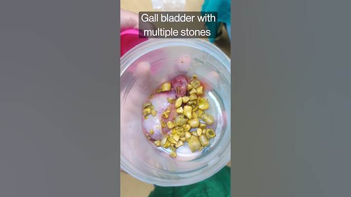 Gall bladder with Multiple stones #healthmedia
