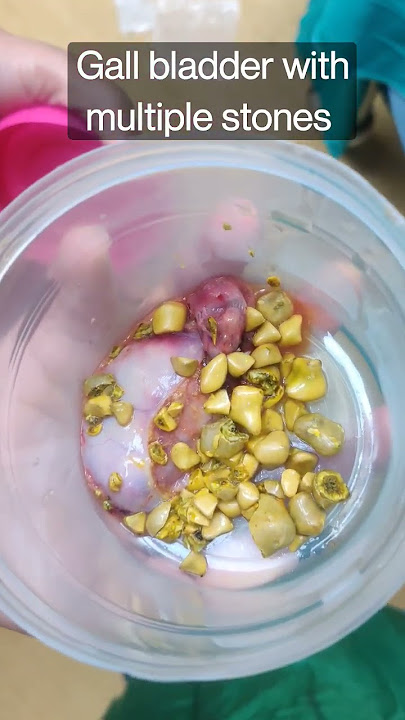 Gall bladder with Multiple stones #healthmedia