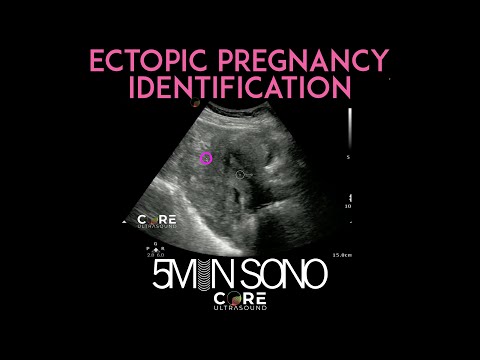 Image of Point-of-Care Ultrasound for Ectopic Pregnancy Identification (5MS)
