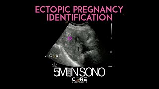 Point-of-Care Ultrasound for Ectopic Pregnancy Identification (5MS)