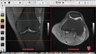 Systematic Interpretation of Knee MRI: Supplemental Cases