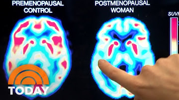What is ‘menopause brain’ and how can people navigate it?