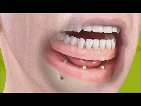 Video: Hur man bär tandproteser
