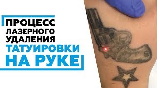 Удаление тату на руке в Ростове-на-Дону #удалениетатуажаростов #удалениетатуростов Удаление тату на руке в Ростове-на-Дону #удалениетатуажаростов #удалениетатуростов