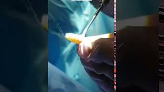 Dr Bora Ok Md - In Closed Rhinoplasty Contouring The Rib Cartilage For Bridge Augmentation