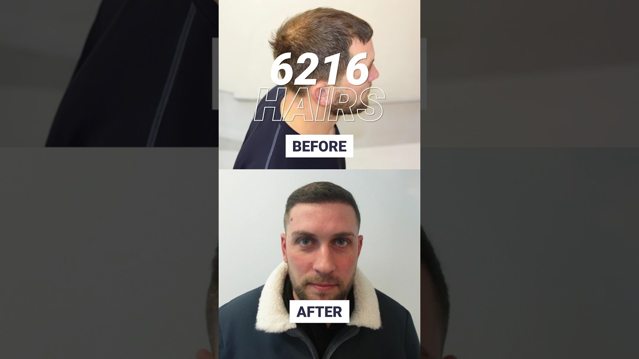 Even density with 2400 grafts to the hairline and crown!