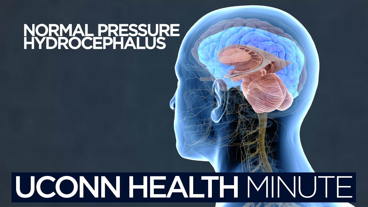 Normal Pressure Hydrocephalus normal-pressure-hydrocephalus