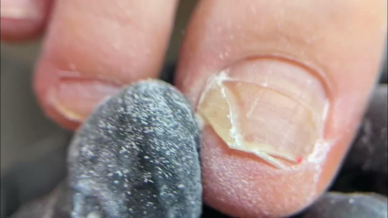 Сюрприз на педикюре😢.#ногтимосква #маникюр #подология #педикюр - YouTube