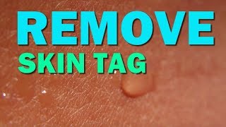 Get Rid of Skin Tags In 1 Week | How To Remove Skin Tag Easily