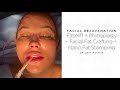 FACIAL REJUVENATION: Facelift + Facial Fat Grafting + Nano Fat Stamping  by Dr. Gary Motykie