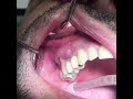 Popping a Tooth Abscess