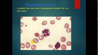 pathology - dr. Tahseen -- Anemia of ( Iron, B12 , Folic acid deficiency)فقر الدم