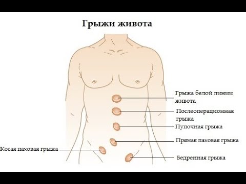 Грыжа слева внизу живота у женщин симптомы. Грыжа живота классификация.