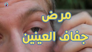 ما هي أسباب انتشار مرض جفاف العينين ؟ ما هي أعراض المرض و طرق الوقاية والعلاج ؟