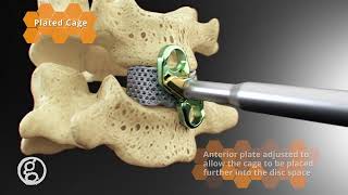 The HIVE Standalone Cervical System - NanoHive Medical - 4K Spine Animation