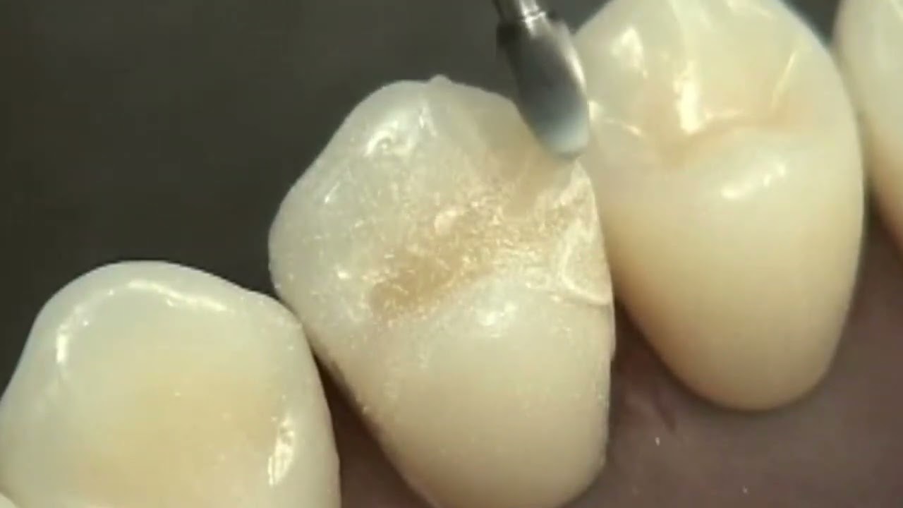 مداواة الأسنان الترميمية(2): تحضير وترميم ضاحك اول صنف 2