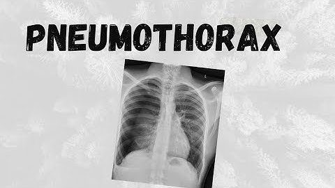 Understanding Pneumothorax: Causes, Symptoms, and Treatment Explained