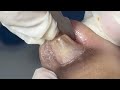 Ep_6659 Foot nails skin removal 👣 กลัวถอดเล็บ ไม่กล้าใส่คัชชูค่ะ 😄 (clip from Thailand)