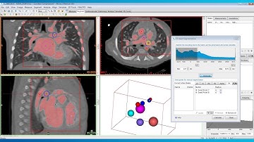How to Semi-Automatically Segment the Heart | Mimics Innovation Suite | Materialise Medical