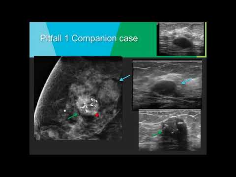 Breast Ultrasound Workshop  Pitfalls Ultrasound Video Lecture