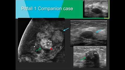 Breast Ultrasound Workshop  Pitfalls Ultrasound Video Lecture