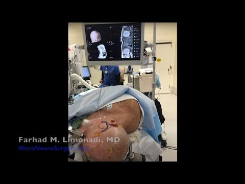 Brain Tumor Surgery: Video clip of a large brain tumor (meningioma) being resected.