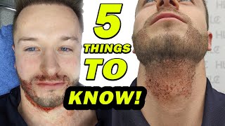 5 Things to Know before Your Beard Transplant!!!