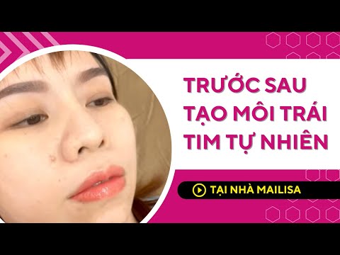 Video Cận Cảnh Trước - Sau Cắt Tạo Môi Trái Tim Tại TMV... - youtube