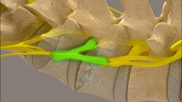 Lumbar Decompression Animation - KDT Neuralflex