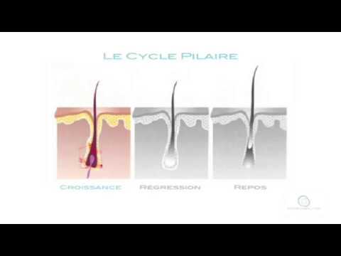 L'Épilation au Laser : comment ça marche ?