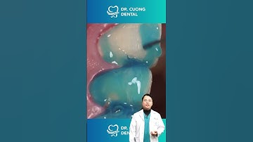 Tháo răng thôi nào |Dr Cường Official