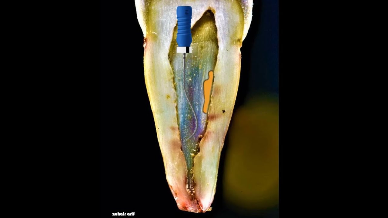 آلية التعامل مع بقايا الغوتا بيركا العالقة داخل الاقنية د مالك أشقر