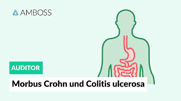 Wie unterscheiden sich Colitis ulcerosa und Morbus Crohn?