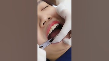 [CẬN CẢNH] THÁO MẮC CÀI NIỀNG RĂNG KIM LOẠI TỰ BUỘC 3M